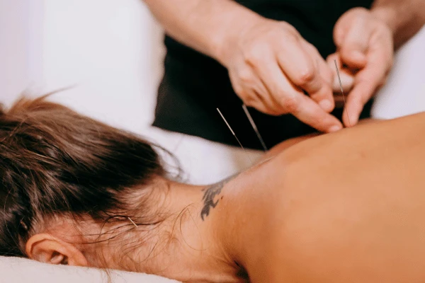 Dry Needling Mill Park